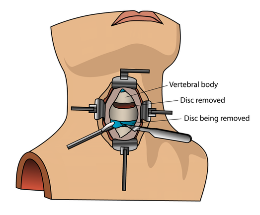 Minimally Invasive Surgical Spinal Decompression