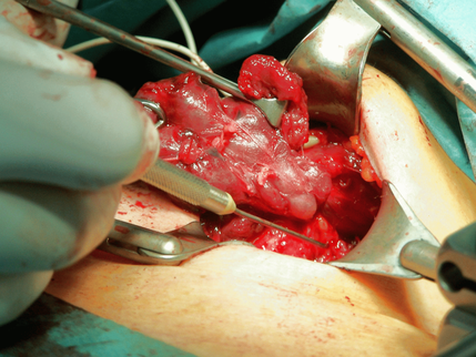 Minimally Invasive Spinal Surgery is not as Minimally Invasive as Spinal Decompression Therapy
